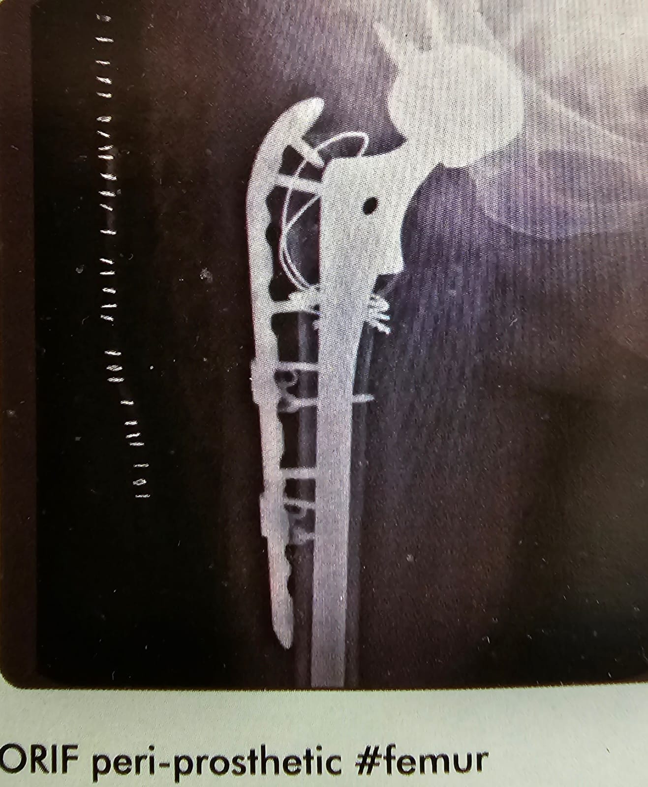 orif peri prosthetic femur