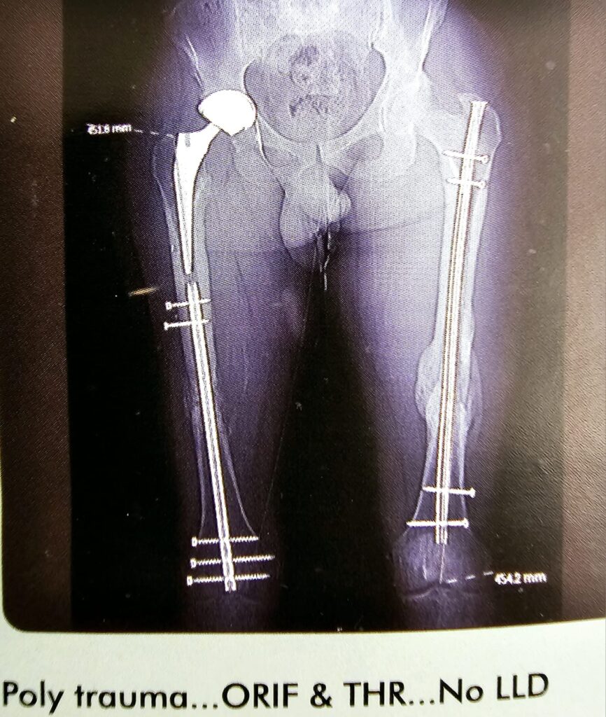 poly trauma orif &thr