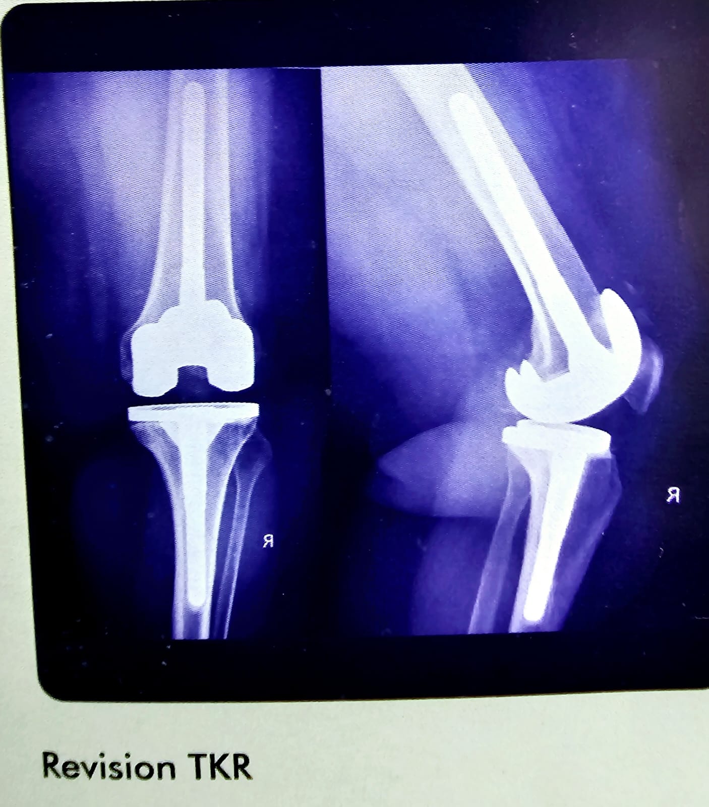 revision tkr