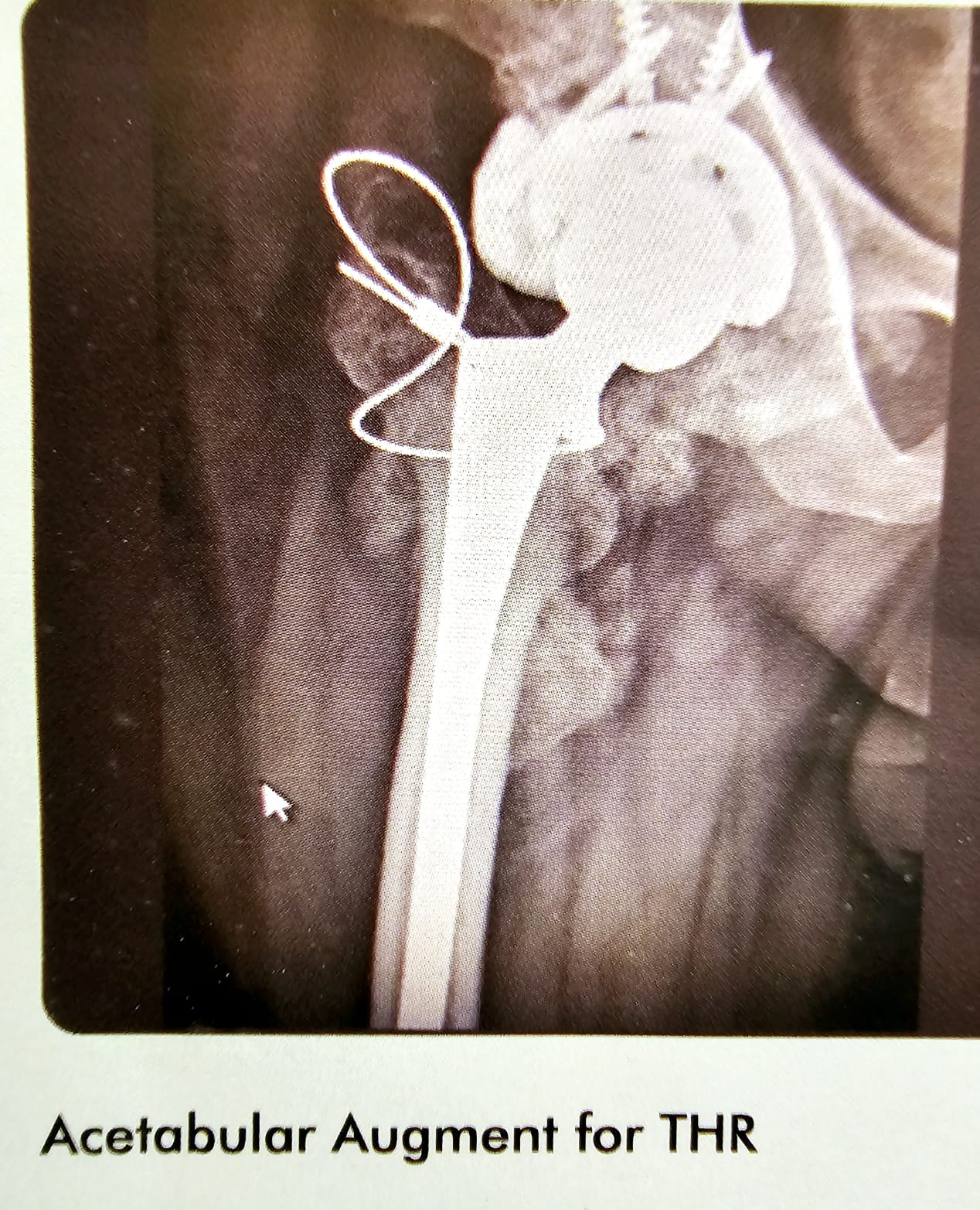 acetabular