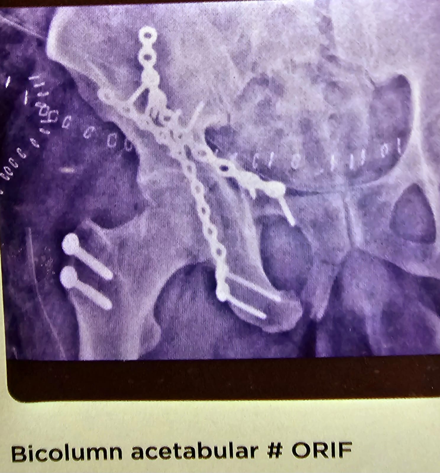 bicolumn acetabular