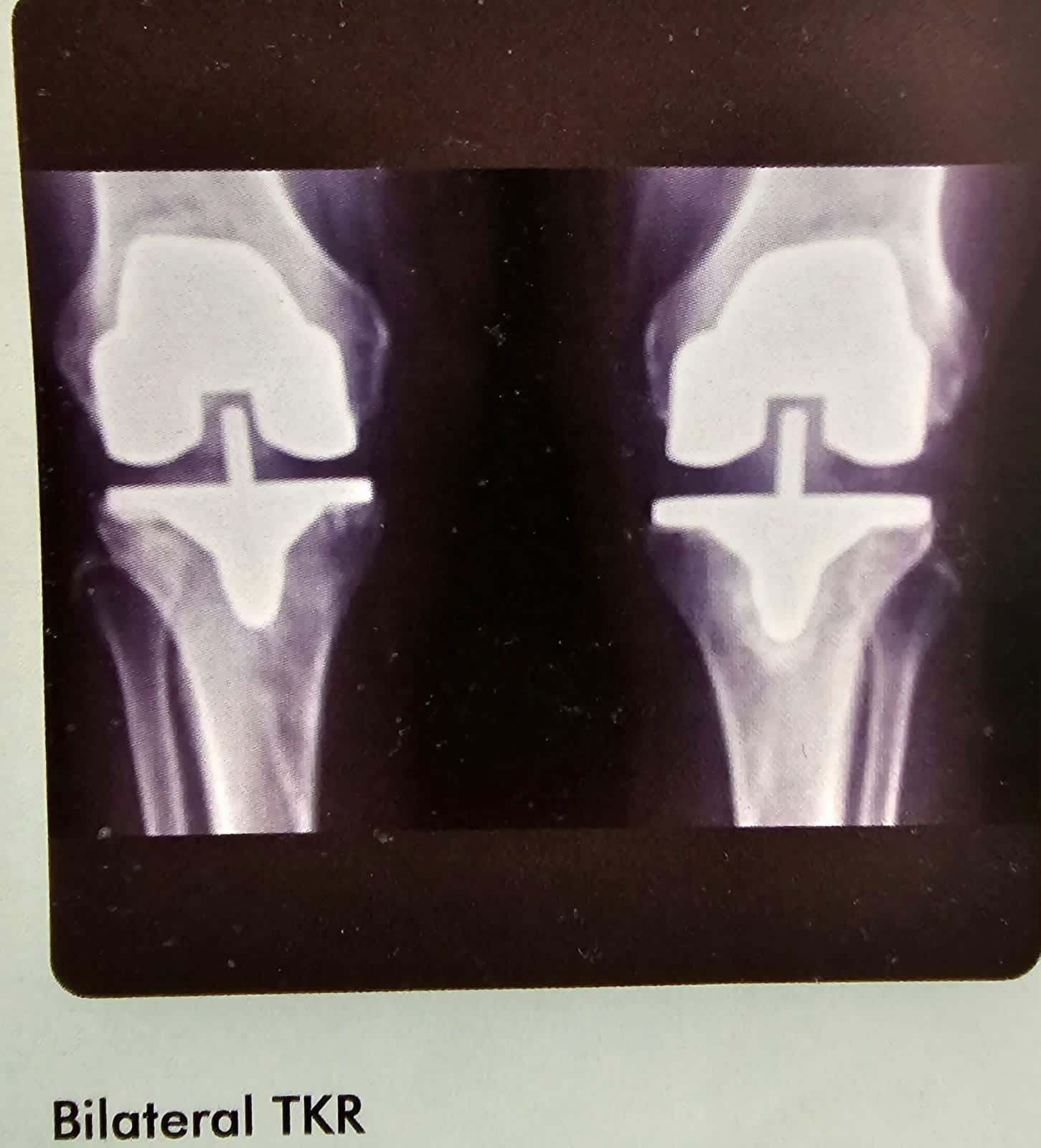 bilateral tkr