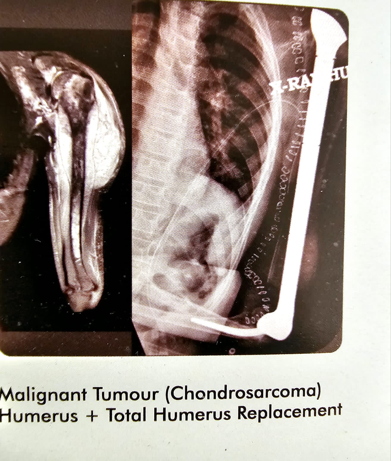 malignant tumor